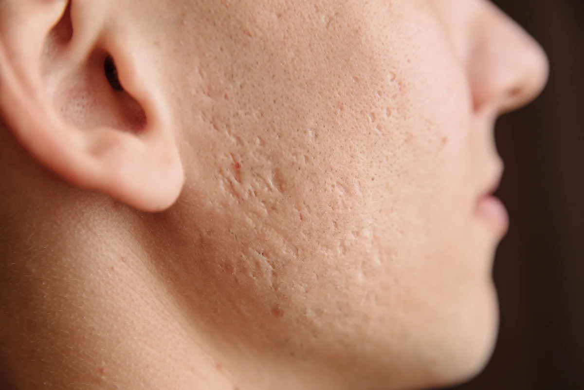 Chemical Peels for Acne Scars